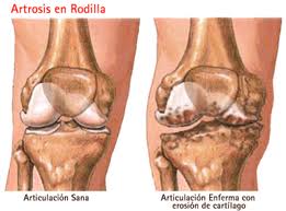 artrosis rodilla